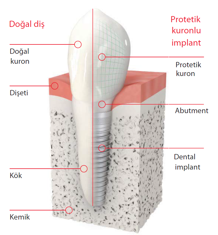 DENTAL İMPLANTLAR
